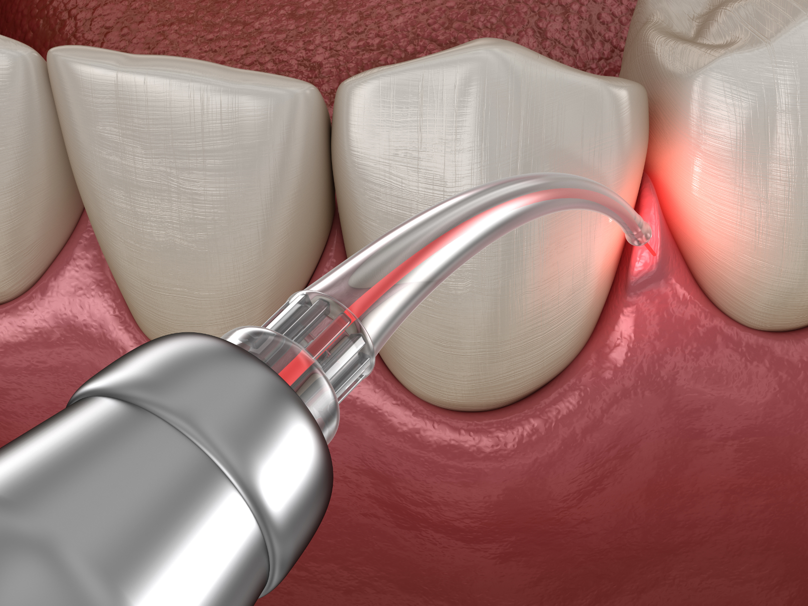 Gum Treatment