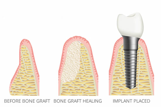 bonegraft1