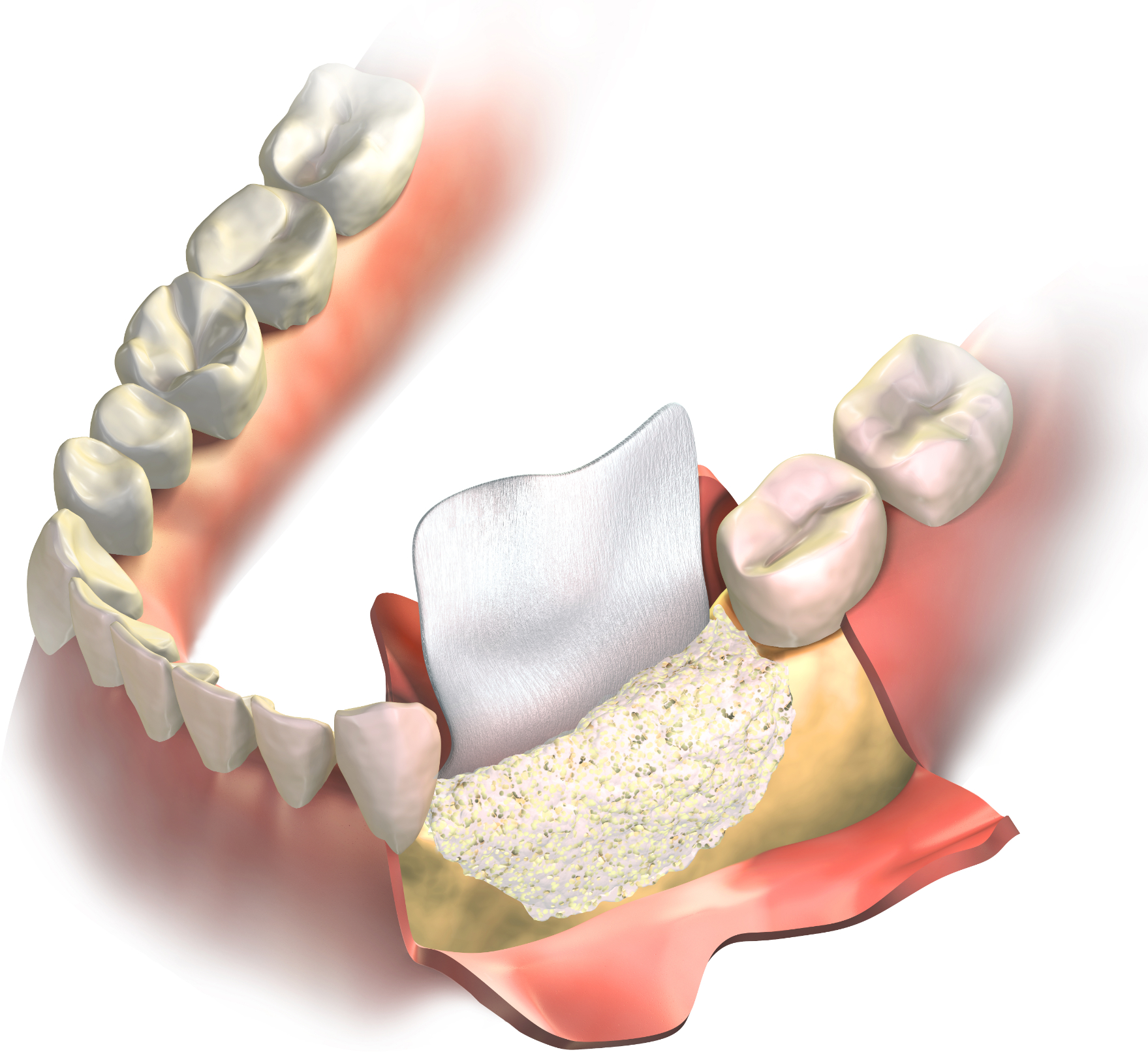  Regenerative collagen membrane placed between the gums and bone graft