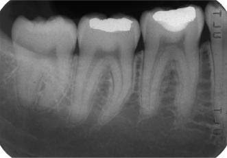 Periapical (PA) X-ray