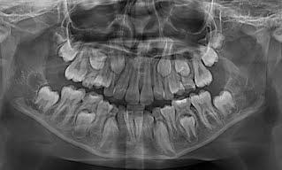 Panoramic X-rays for Treatment PlanninG